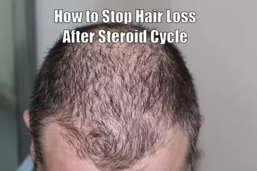How to Stop Hair Loss After Steroid Cycle