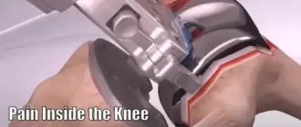 Pain Inside the Knee After TKR (Total Knee Replacement)