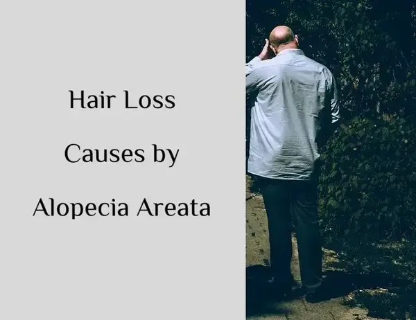 How to Prevent Hair Loss Causes by Alopecia Areata?
