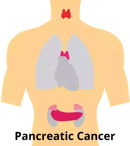 Pancreatic Cancer