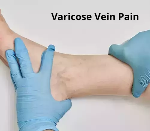 Pain in varicose veins