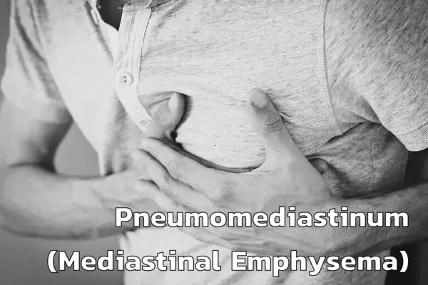 Pneumomediastinum (Mediastinal Emphysema)