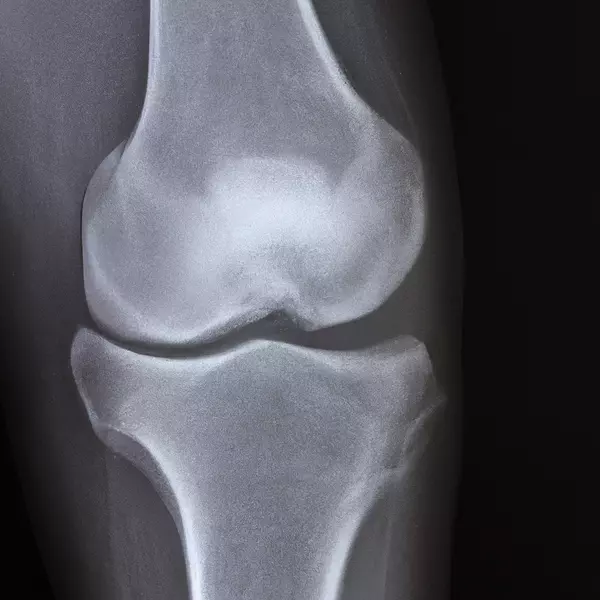 Torn Meniscus of the Knee Joint (x-ray)