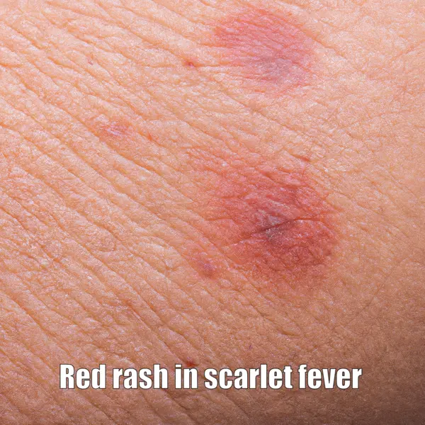 Red rash in scarlet fever