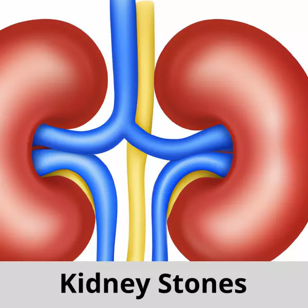 Kidney Stones