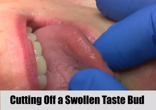 Cutting Off a Swollen Taste Bud Procedure