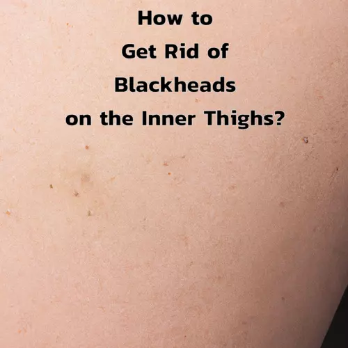 How to Get Rid of Blackheads on the Inner Thighs?