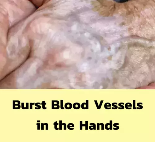 Burst Blood Vessels in the Hands