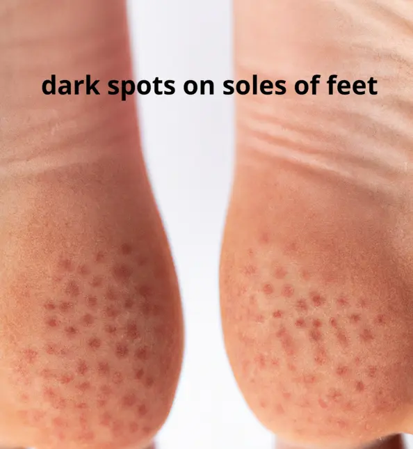 Dark Spots on the Soles of the Feet