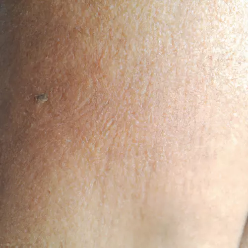 light brown spots on legs