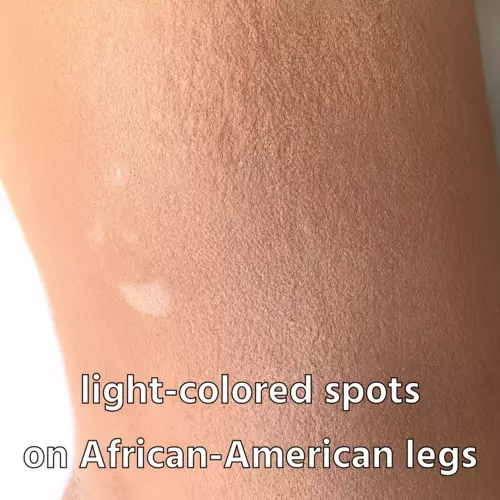 light-colored spots on African-American legs