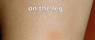 a light brown spot on the leg
