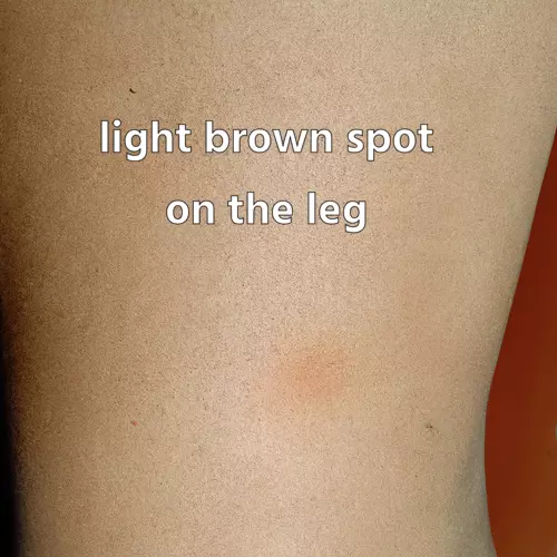 a light brown spot on the leg