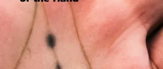 Black Spots on the Palm of the Hand