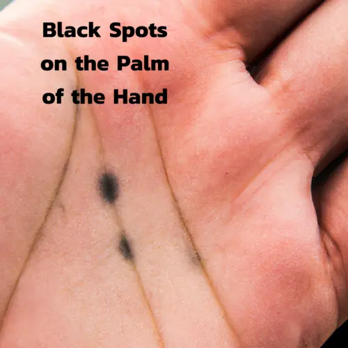 Black Spots on the Palm of the Hand