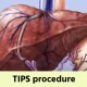 TIPS procedure