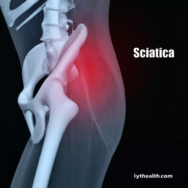 Sciatica