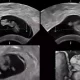 Ultrasound for pregnancy