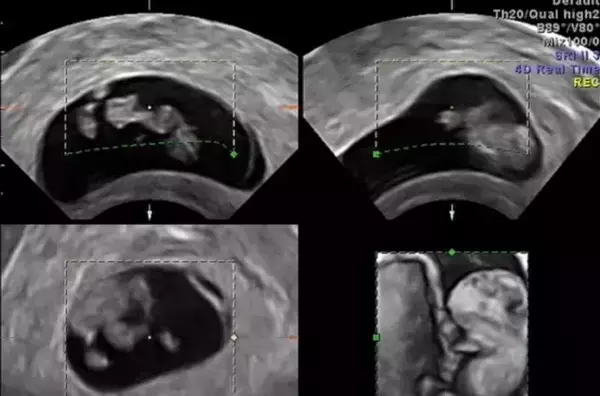 Ultrasound for pregnancy