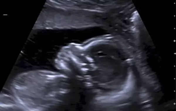 Pregnancy Ultrasound