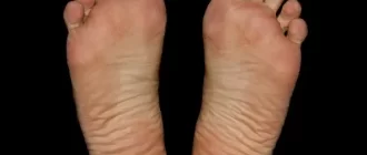 Midfoot Pain