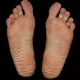 Midfoot Pain