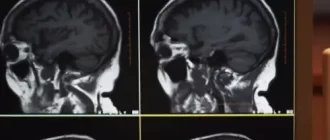 The Difference Between a CT Scan and an MRI of the Brain