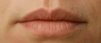 flaky dry skin around the mouth and chin