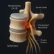 Detailed 3D medical illustration showing a herniated disc at the L4-L5 level compressing spinal nerve roots—one of the most common causes of sudden leg weakness and inability to stand. The compressed nerve is highlighted in red, helping explain how spinal issues can lead to collapsing legs or nerve-related mobility loss.