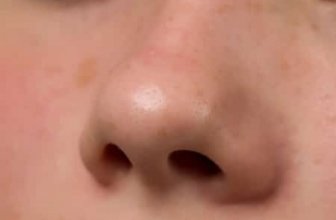 Why My Nose Itches on Outside?