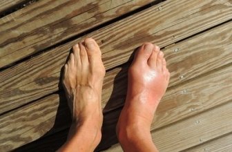 Ankle Swelling: Causes and Remedies