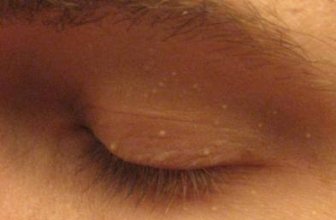 White Spots on Skin from Sun