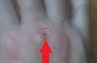 Pinched My Finger Blood Clot